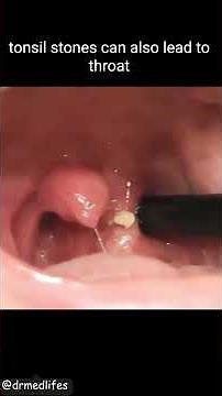 Tonsil stone removal | tonsil stone treatment removal #tonsilstones #tonsil
