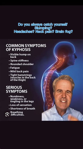 2.9K views · 20 reactions | #forwardheadposture and #cervical...