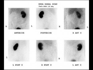 Renal DMSA scan (technetium 99m DMSA scan) (Dimercaptosuccinic Scan) ; Defnition, Procedure, Uses