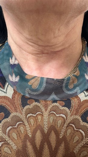 Alexander Golberg MD, DO on Instagram: "Transformation doesn’t have to be dramatic to be meaningful. This non-surgical neck lift restores contour, smooths texture, and supports skin integrity through precise, anatomy-led technique and regenerative care — without surgery or downtime. The goal is harmony: a neck that looks refined, natural, and in balance with the face as it moves and ages. Dr. GolBerg Concierge and Aesthetic Medicine, Dr. GolBerg NYC, non surgical neck lift NYC, neck lift without