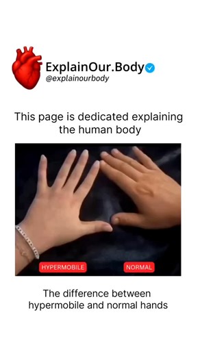 HEALTH | MEDICAL | LIFE on Instagram: "Spot the difference! 🖐️ On the left, we see hypermobility, where joints move beyond the normal range of motion. While it might look like a 'party trick,' for those with Ehlers-Danlos Syndrome (EDS), it can lead to joint pain and instability. #Hypermobility #EDS #MedicalEducation"