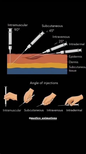 Dr. Samrin Sayed on Instagram: "Ever wondered why some shots go in your arm muscle and others just under the skin? Here's the breakdown: Intramuscular (IM) + Deep into the muscle (vaccines, hormones) Subcutaneous (SC) + Into the fatty layer (insulin, blood thinners) Intravenous (IV) → Straight into the vein (instant effect) Intradermal (ID) + Just under the skin surface (TB tests, allergy testing) Intraosseous (IO) → Into bone marrow (life-saving emergency route when veins collapse) Fast absorpt