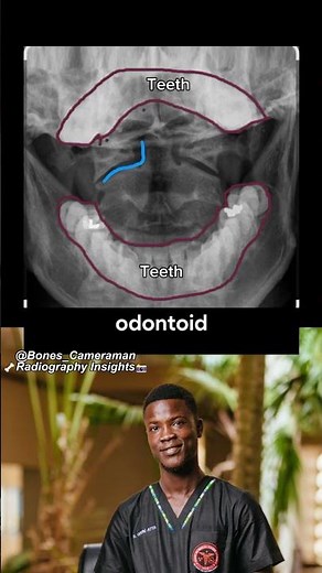 Cervical Spine X-ray Views Explained | AP, Lateral & Open Mouth (Odontoid)