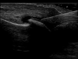 Ultrasound guided injection of the 1st MTPJ