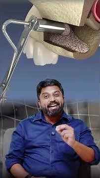 Sinus Lifting: Types & Benefits Explained | Dr.Prem Alex Lawrence