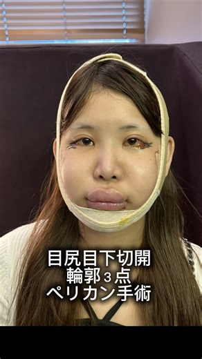 目と輪郭、同時にここまで変わる。目尻目下切開、ペリカン手術、輪郭3点手術を受けました。それぞれ単体でも印象は変わりますが、組み合わせることで顔全体のバランスが一気に整います。