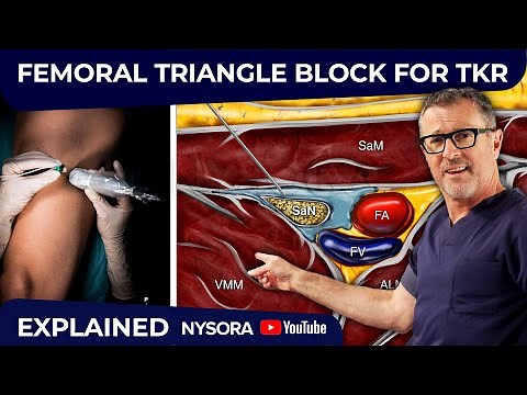 Femoral Triangle Block For TKR