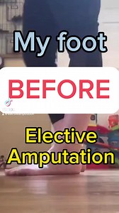 209K views · 421 reactions | My foot and walking #beforeamputation #electiveamputationI would search the internet truing to find people walking before their amputation in order to justify mine. Your journey and your reasons are your own. This decision is made between you, your trusted core people and your sugeons. Block the negativity and work towards tour 10/10life | Kerri Trammel | Facebook