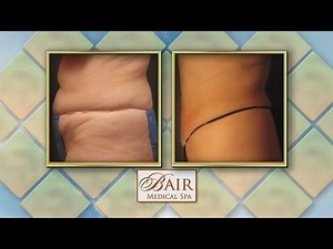 Shed Stubborn Fat with Smart Lipo