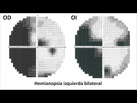 Hemianopsia izquierda bilateral por ictus cerebral