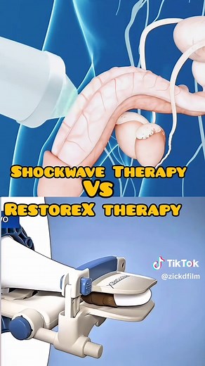 Shockwave Therapy Vs RestoreX Therapy procedure Difference For Peyronies Disease #peyroniesdisease #shockwavetherapy #RestoreX #peyronies #healtheducation