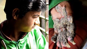 A year after ‘cure,’ Bangladesh’s ‘Tree Man’ again shows signs of rare skin condition - National | Globalnews.ca