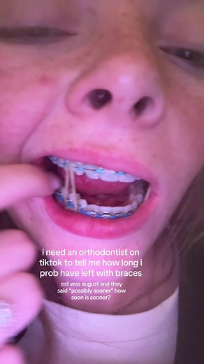 i have disney and a cruise late june and i want them off for the trips. is it possible??🥴 #braces #orthodontistsoftiktok #bracesoff #clearbraces #bracestransformation