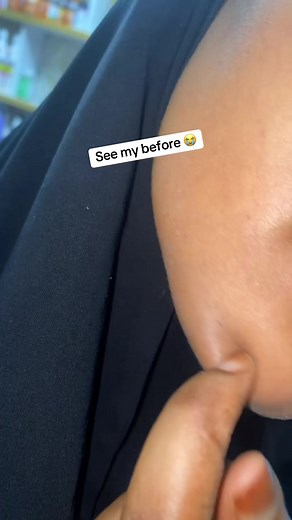 Understanding Skin Discoloration Causes and Solutions
