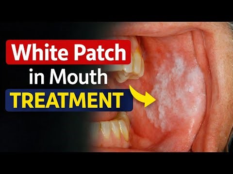 Day-125 White Patch in Mouth? Watch This Before It’s Late ‪@Smilediariesindia‬
