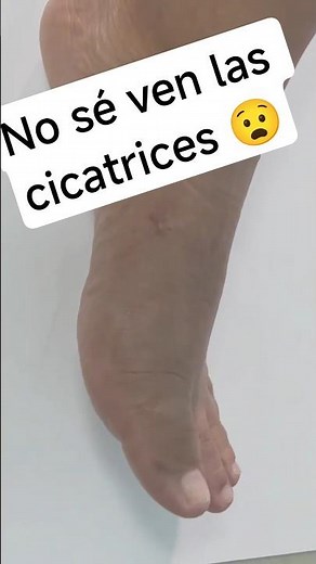 NO SE VEN LAS CICATRICES 😧😧"¿Cómo es la cirugía MICA de juanetes? 🦶"