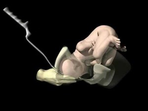 Forceps Delivery (sample) - www.proceduresconsult.com