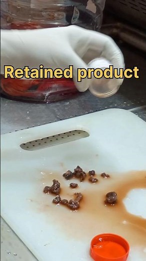 Retained product of conception for histopathology 😭| #histopathology #endometriosis #abortion #lab