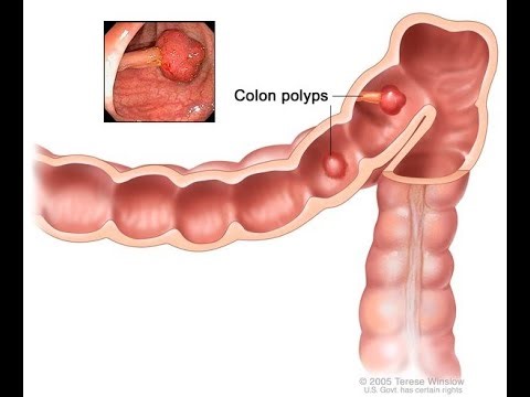 Hereditary non polyposis colorectal cancer HNPCC or Lynch syndrome