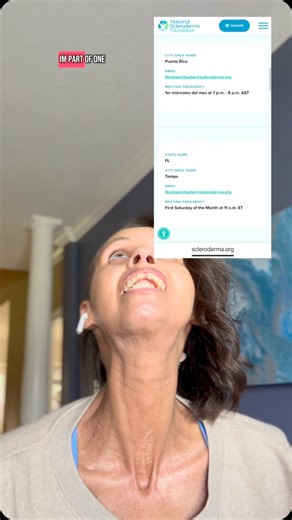 She Shutes on Instagram: "Stretching the mouth and neck is SO beneficial to me as someone with Scleroderma. I found these stretches on the National Scleroderma Foundation website. Let’s look at some other resources on their website….i know I’m partnering with them for Scleroderma Awareness Month, but I’ve been using their website for a couple years. It’s such a valuable resource! @sclerodermaus #scleroderma #stretching #sclerodermaawareness #sclerodermawarrior"