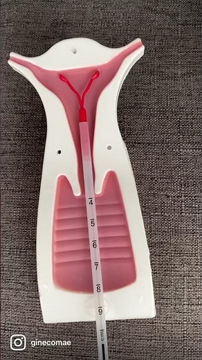 Sabe oq é isso? #shorts #diu #gravidez