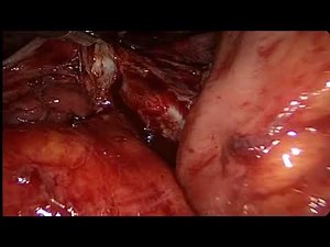 B/L Chocolate Cyst • Video • MEDtube.net