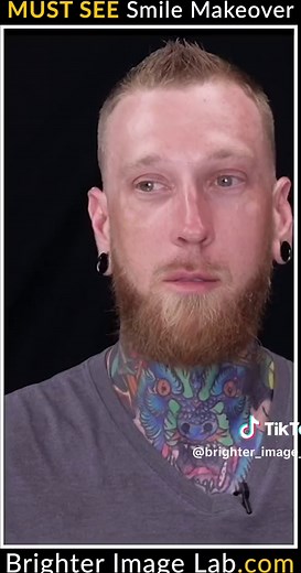 Check out this awesome before-and-after smile makeover - you won’t believe the transformation. Seriously, what would a new smile do for you? #veneers #smilemakeover #smiletransformation #dentalveneers #brighterimagelab #beforeafter #confidence #smile