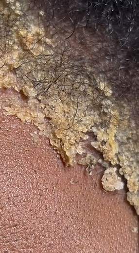 242K views · 598 reactions | removal dandruff scalp asmr sound scratching | Showerer | Facebook