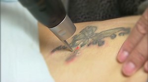 Improvements in tattoo removal