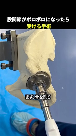 股関節がボロボロになると受ける手術