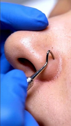 Satisfying Nose Crease Pore Cleaning ✨