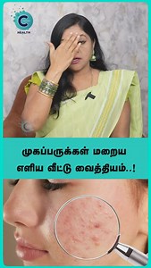 64K views · 116 reactions | How to remove a pimple quickly? • #pimples #bhfyp #natural #skincare #selfcare #cosmetics #skin #skincareroutine #flawless #antiaging #facial #glowingskin #jerawat #acne #beautytips #healthyskin #naturalskincare #skincaretips #skincareproducts #oriflame #whitening | Cosmo Health | Facebook