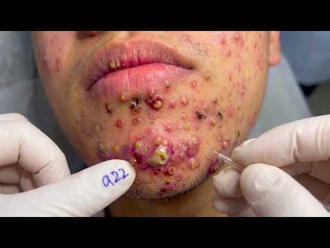 cystic acne blackhead whitehead removal | Relaxing Spa Acne Treatment
