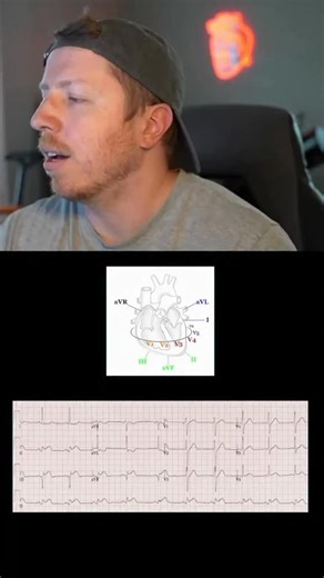 NurseDosePodcast on Instagram: "My method for identifying STEMI locations. This is super helpful for also determining what leads to primarily monitor at the bedside (CABG, post stent etc) . Check out the ICU STARTER BUNDLE and the other Nurse Dose Cheat Sheets/Resources in the bio! . Follow for more ICU nursing education! 🎓 . #cvicu #cardiacnurse #criticalcare #nursingschool #icunurse"