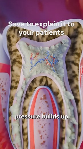 Dental Mentor Pro ®️ on Instagram: "A quick video explaining how and what happens during a dental infection • . Dm for creds"