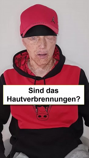 Understanding Signs of Skin Burns in Everyday Life