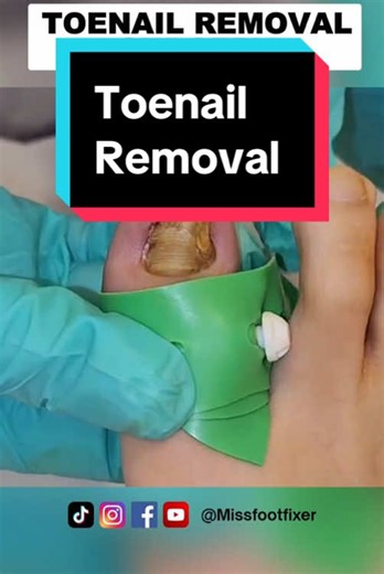 Complete Toenail Removal Surgery Explained
