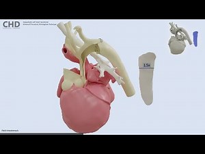 Norwood (Birmingham) Procedure for Hypoplastic Left Heart Syndrome