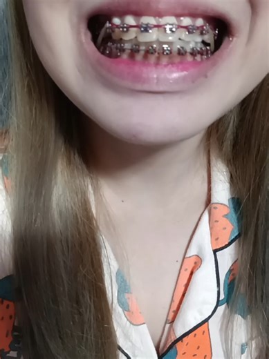 Tooth Extraction Journey with Braces