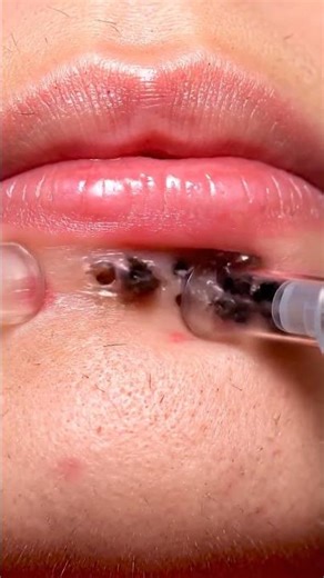 Relaxing Vacuum Blackhead Removal Near Lips #blackheadcaique #skincare #pimple #viral