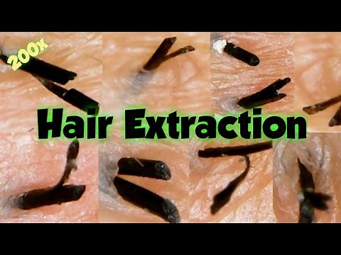 Hair ingrown?NO! .. HAIR EXTRACTION |Thick hair + split Ends | Satisfying close up Extraction