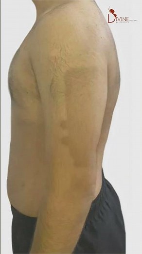 Gynecomastia Grade 2A Results After 3 Months