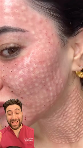 Polynucleotide injections to the ENTIRE FACE!?