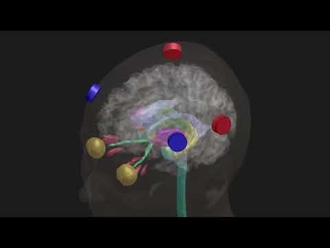 TI Stimulation Optimization