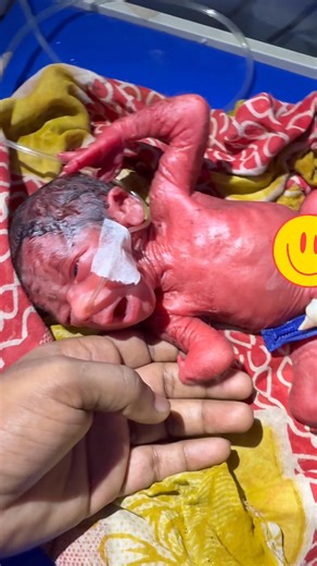 Congenital anomalies baby birth #newbornbaby #nicu #congenitalanomalies | Medical practice