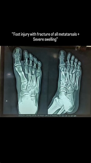 Dr Kulwinder Singh on Instagram: "That’s a serious foot injury. A fracture of all metatarsal bones with severe swelling needs urgent and careful management to avoid long-term problems. 🚨 Red flags that need emergency attention: Increasing pain not relieved by medicines Tight, shiny skin Numbness or tingling in toes Bluish or pale toes Inability to move toes Initial management Strict limb elevation (above heart level) Ice application (intermittent, not directly on skin) Pain control Splintage /
