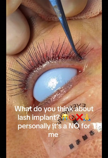 The Risks of Eyelash Implants: A Cautionary Tale