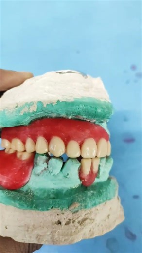 Teeth arrangement for removable partial denture
