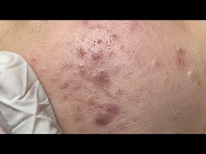 Inflammatory acne on cheeks #HoangMySpa105