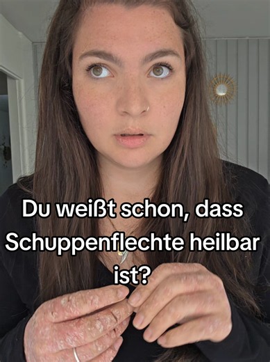Nope. Schuppenflechte ist und bleibt nicht Heilbar Hanspeter #schuppenflechte #psoriasis #psoriasiswarrior #skinfluencer #psodiary